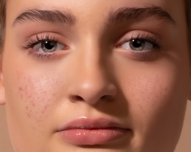 bad-skin-edit